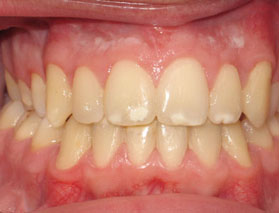 Öppet bett - efter ingrepp