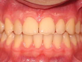 Underbett - efter ingrepp