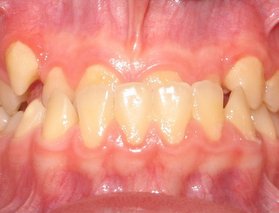 Underbett - före ingrepp